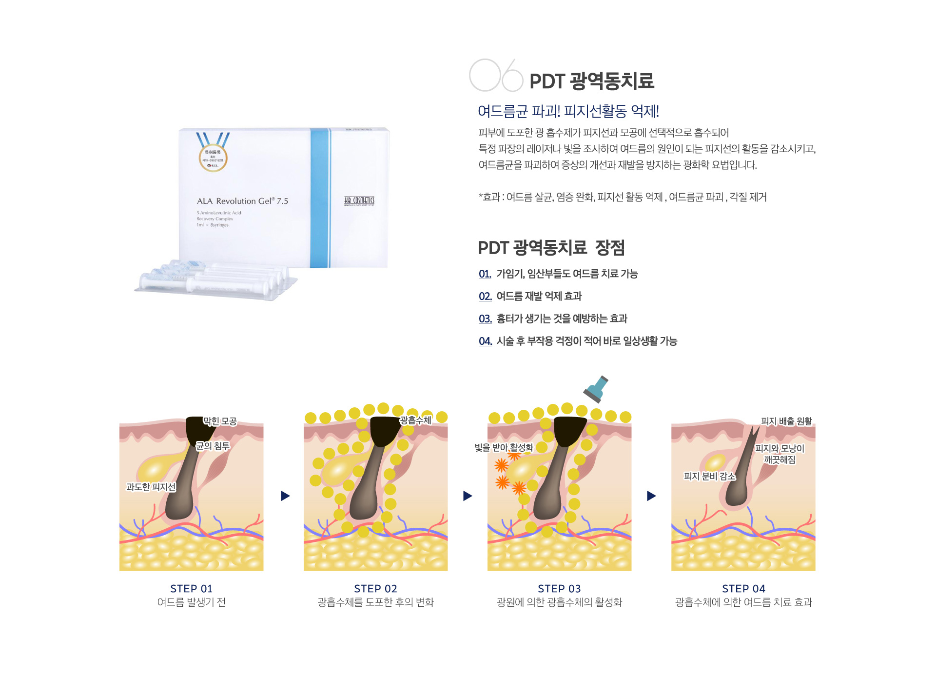 PDT 광역동치료